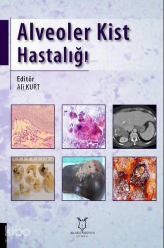 Alveoler Kist Hastalığı - 1