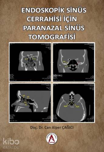 Endoskopik Sinüs Cerrahisi İçin Paranazal Sinüs Tomografisi - 1