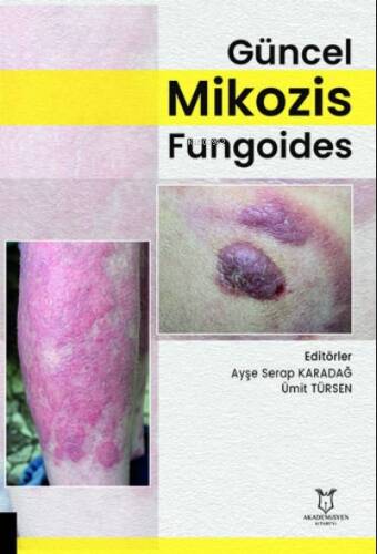 Güncel Mikozis Fungoides - 1