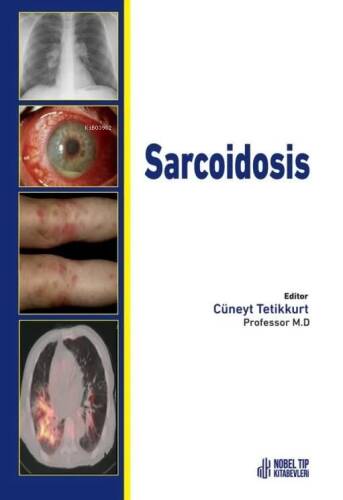 Sarcoidosis - 1