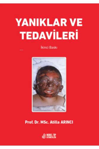 Yanıklar Ve Tedavileri - 1